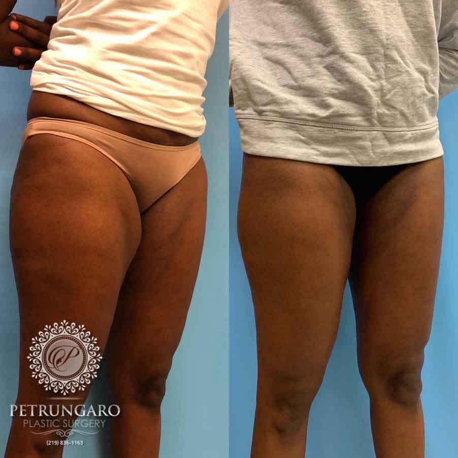 49-before-after-liposuction-inner-thighs-1