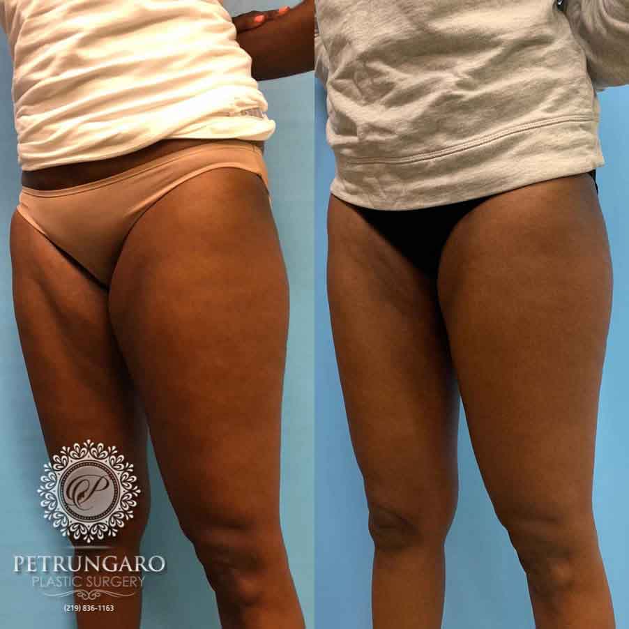 49-before-after-liposuction-inner-thighs-2