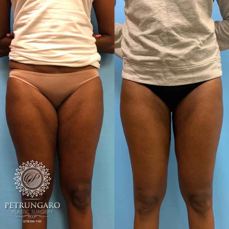 49-before-after-liposuction-inner-thighs-3