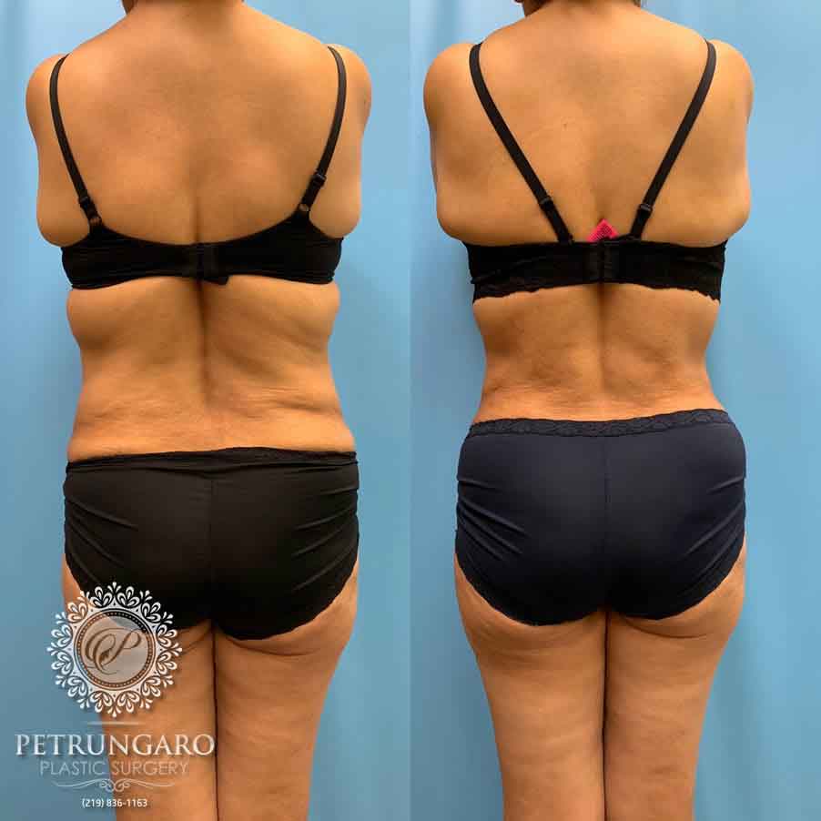 52-before-after-tummy-tuck-lipo-360-1