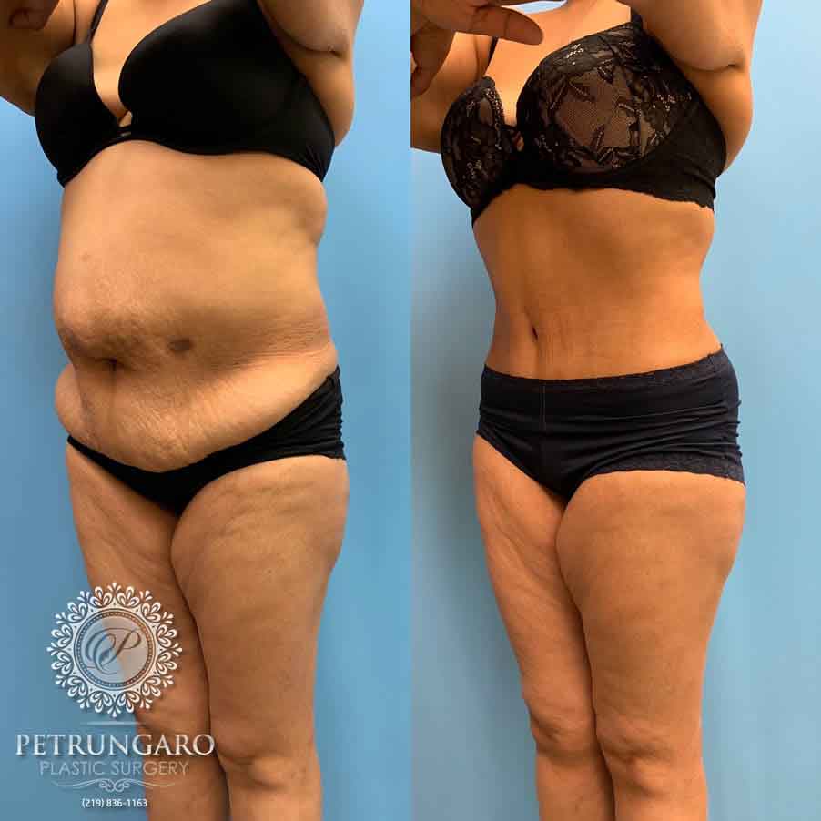 52-before-after-tummy-tuck-lipo-360-2