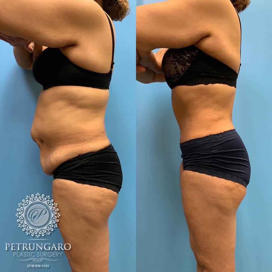 52-before-after-tummy-tuck-lipo-360-5