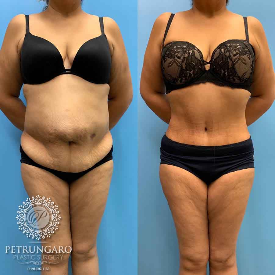 52-before-after-tummy-tuck-lipo-360-6