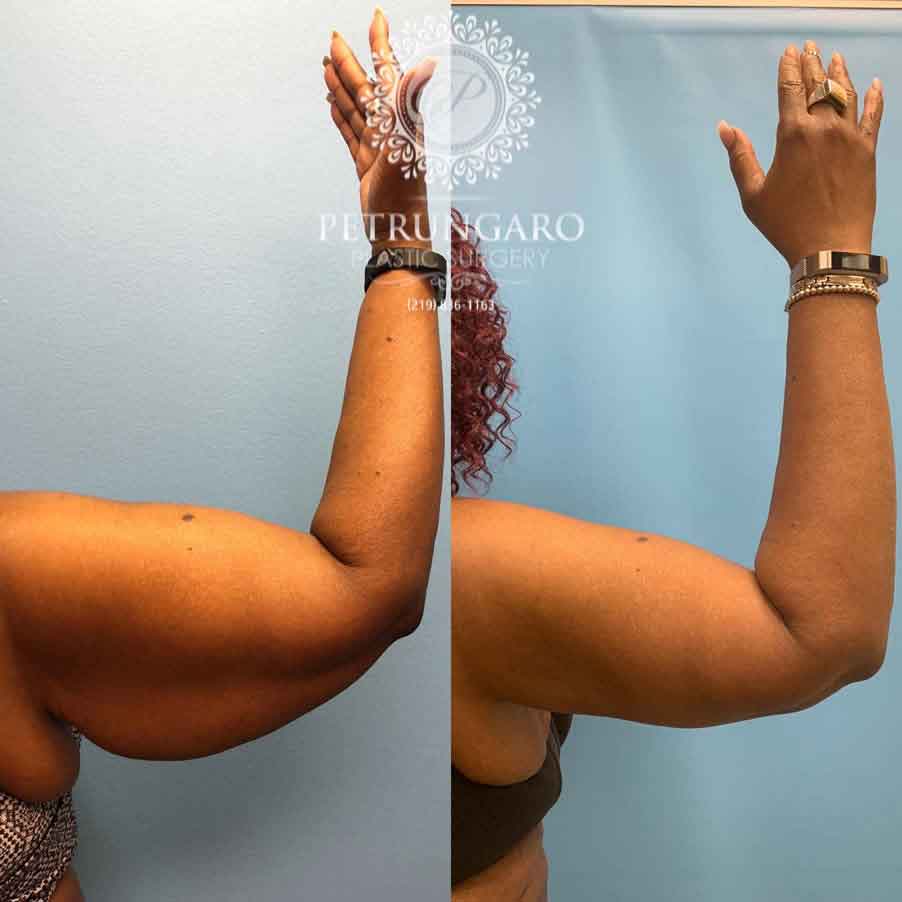 53-before-after-arm-lift-liposuction-1