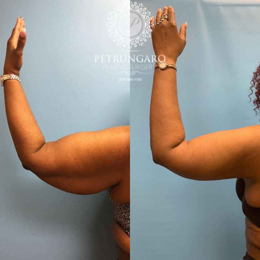53-before-after-arm-lift-liposuction-2