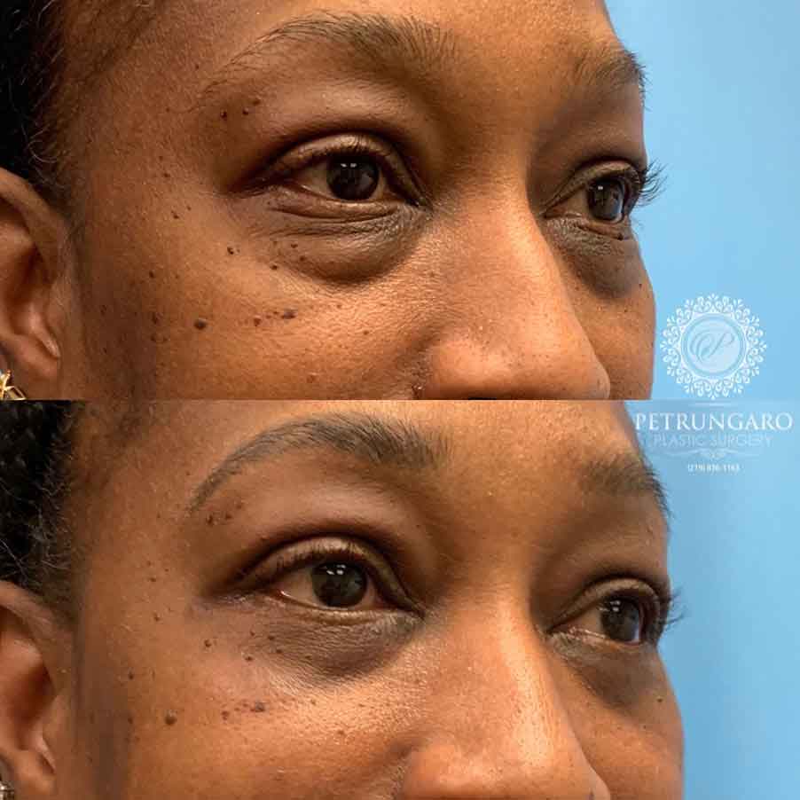 53-before-after-eyelid-lift-3