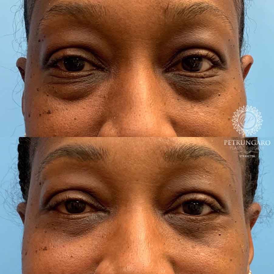 53-before-after-eyelid-lift-4
