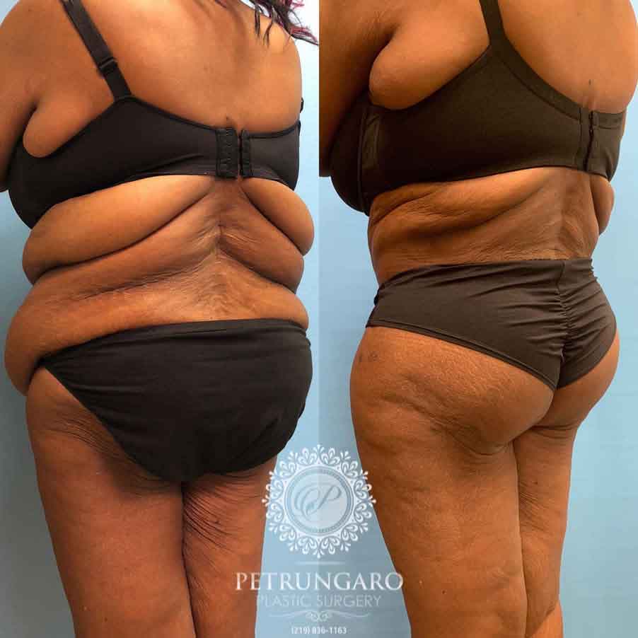 53-before-after-fleur-de-lis-body-lift-liposuction-brazilian-butt-lift-1