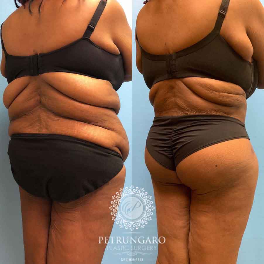 53-before-after-fleur-de-lis-body-lift-liposuction-brazilian-butt-lift-2