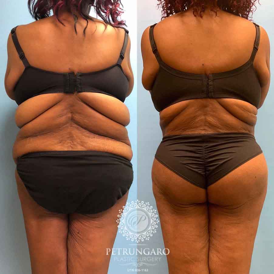 53-before-after-fleur-de-lis-body-lift-liposuction-brazilian-butt-lift-5