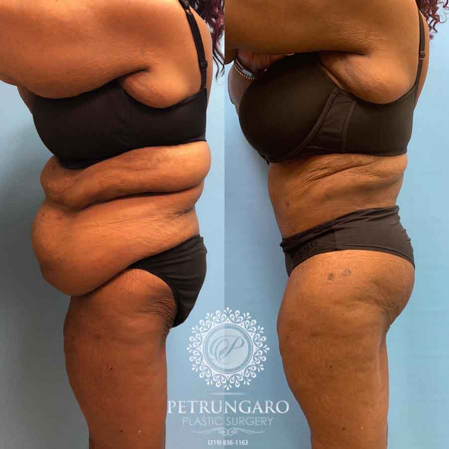 53-before-after-fleur-de-lis-body-lift-liposuction-brazilian-butt-lift-6