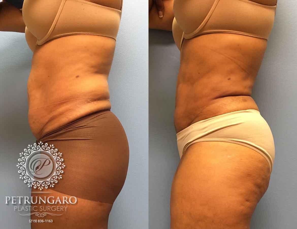 55-year-old-woman-liposuction-a1