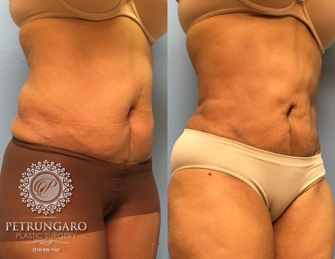 55-year-old-woman-liposuction-a2