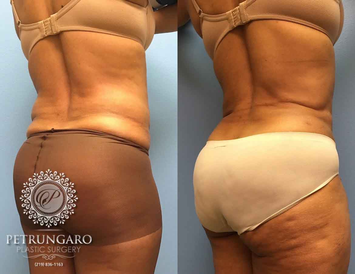 55-year-old-woman-liposuction-a3