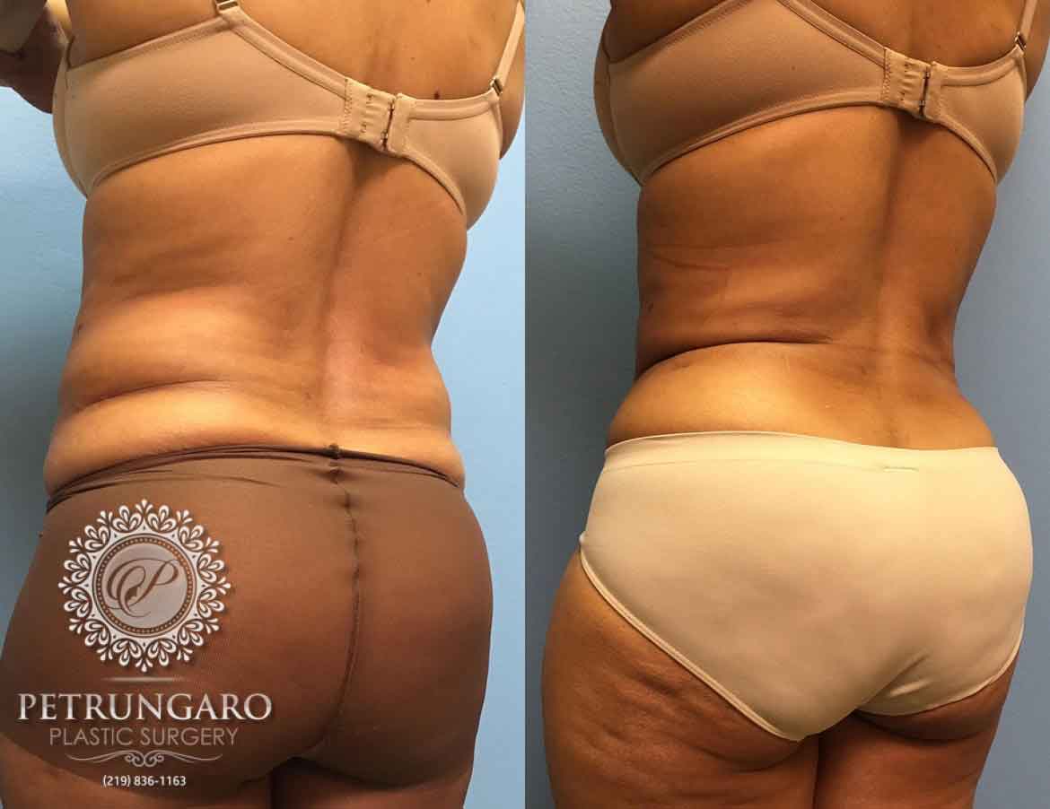 55-year-old-woman-liposuction-a4