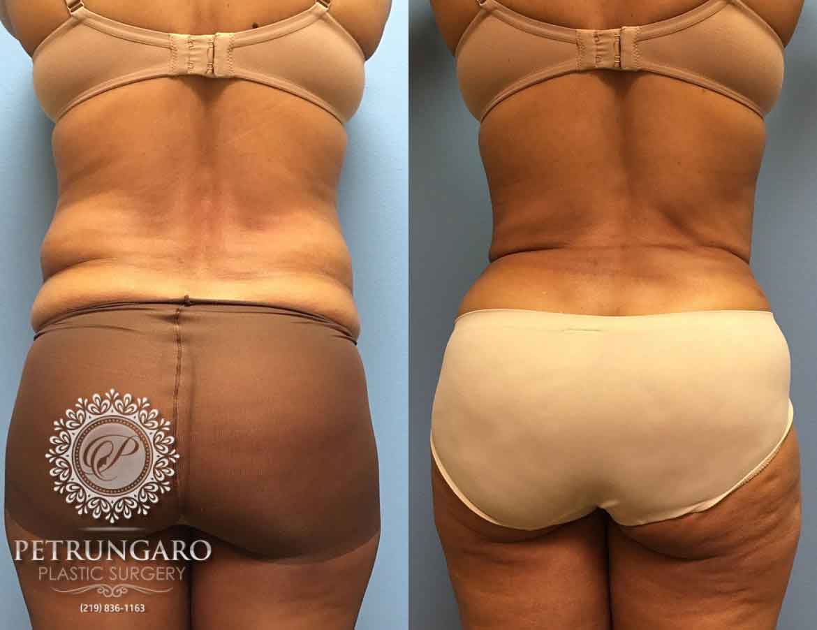 55-year-old-woman-liposuction-a5
