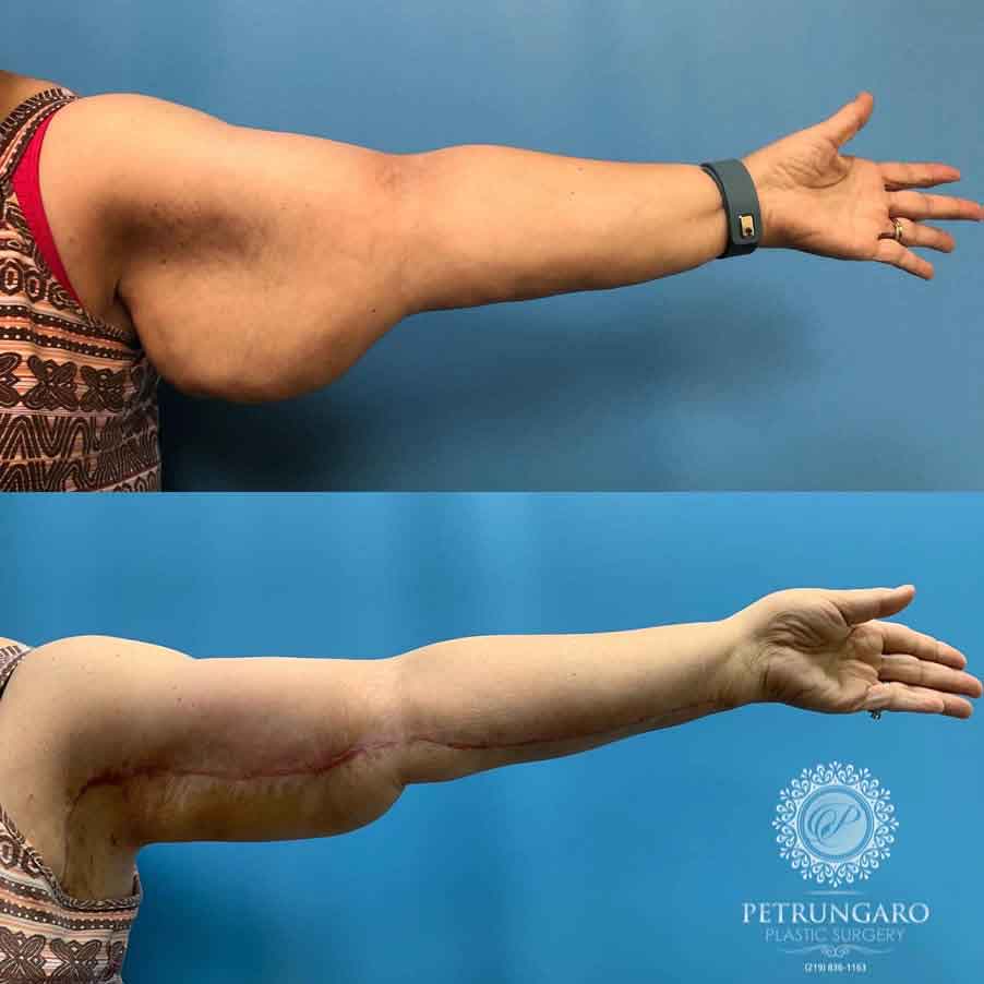 58-woman-before-after-armlift-1