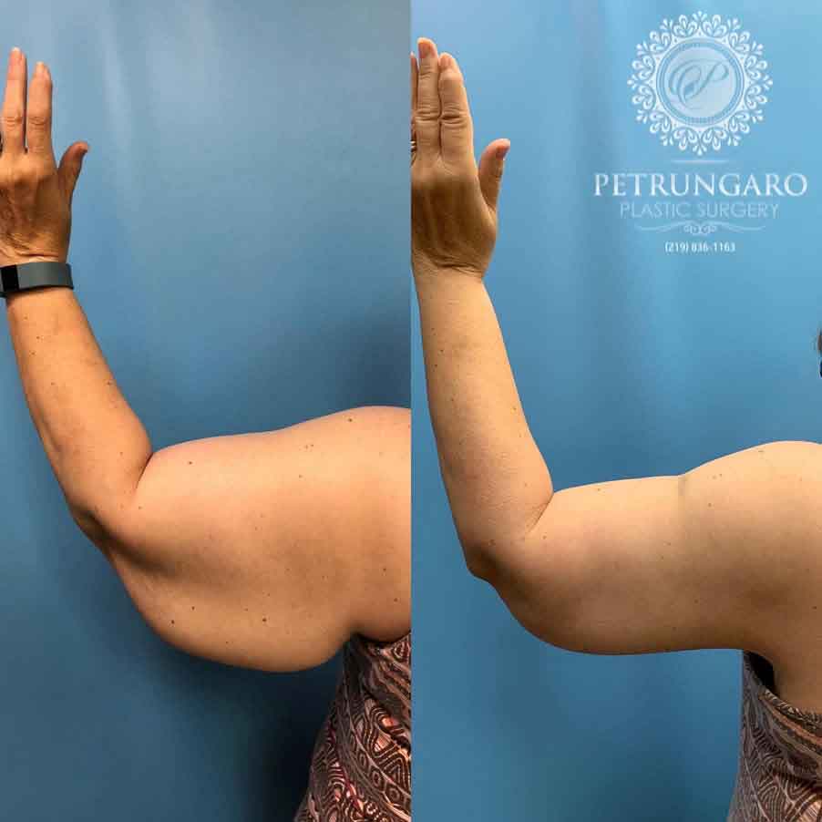 58-woman-before-after-armlift-6