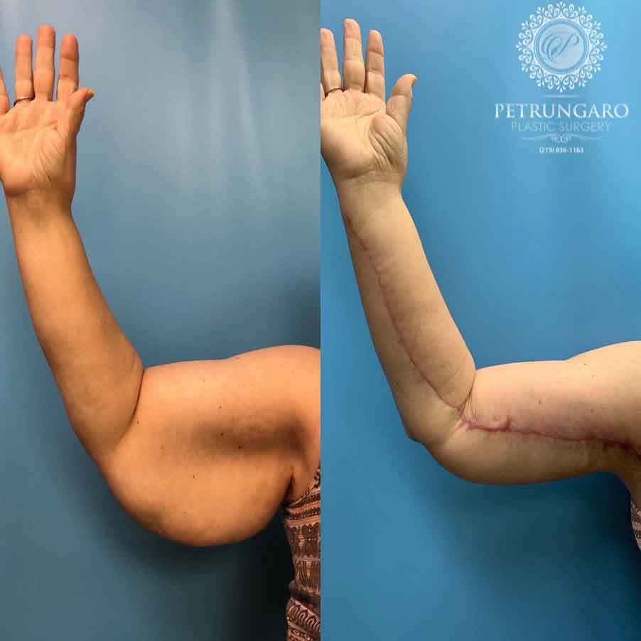 58-woman-before-after-armlift-8