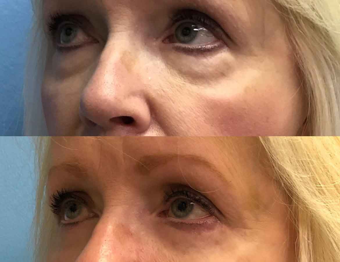 65-female-eyelid-surgery-3