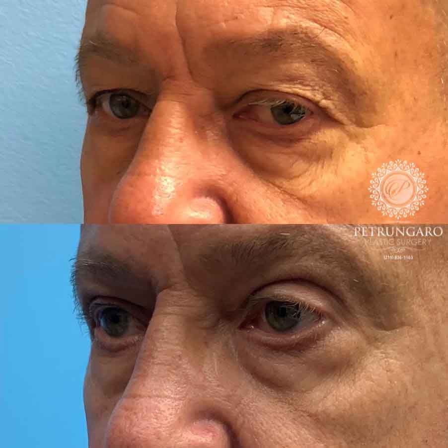 66-man-before-after-photo-upper-eyelid-lift-2