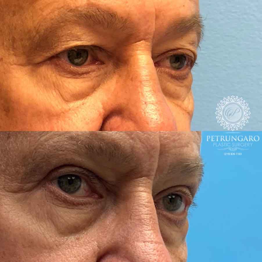 66-man-before-after-photo-upper-eyelid-lift-3