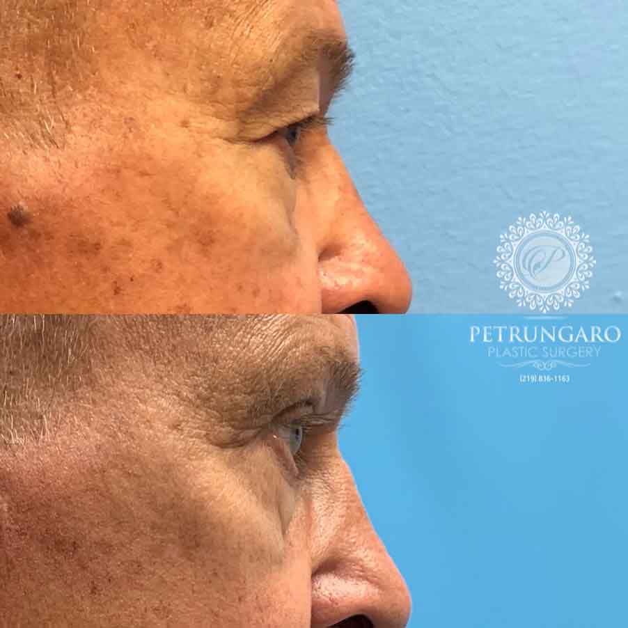 66-man-before-after-photo-upper-eyelid-lift-4