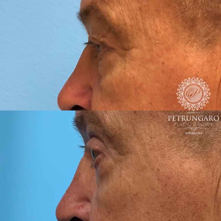 66-man-before-after-photo-upper-eyelid-lift-5
