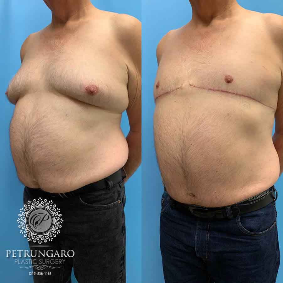67-male-before-after-breast-surgery-1