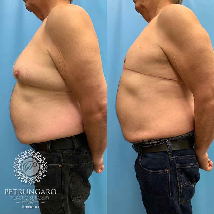 67-male-before-after-breast-surgery-4