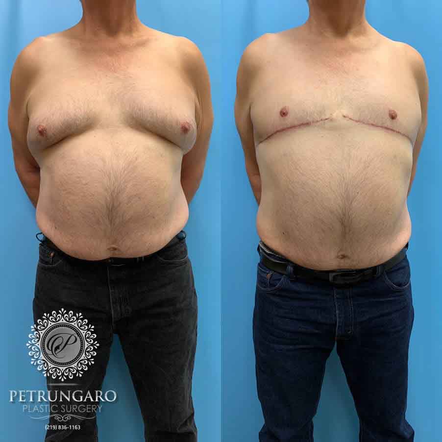 67-male-before-after-breast-surgery-5
