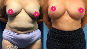 69-breast-augmentation-mommy-makeover-feature-newf