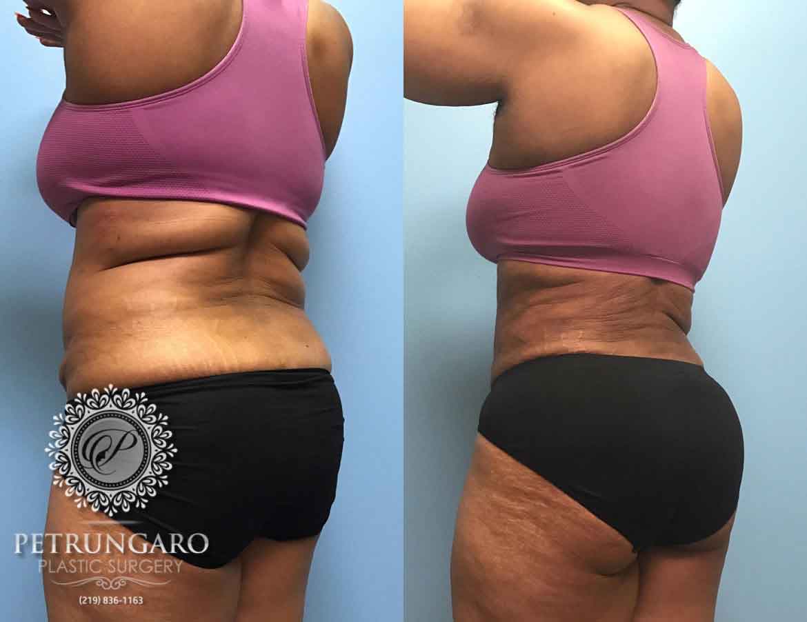 before-after-Liposuction-2g-1