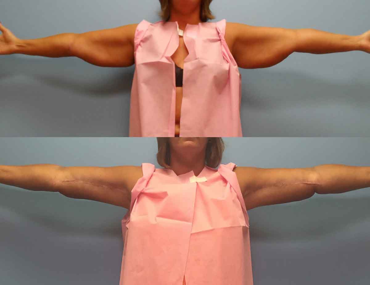 before-after-arm-lift-1b
