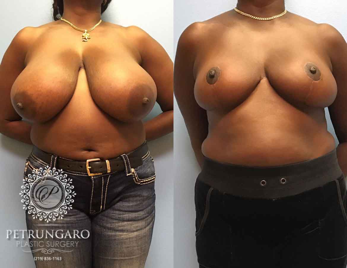 before-after-breast-reduction-1a-1