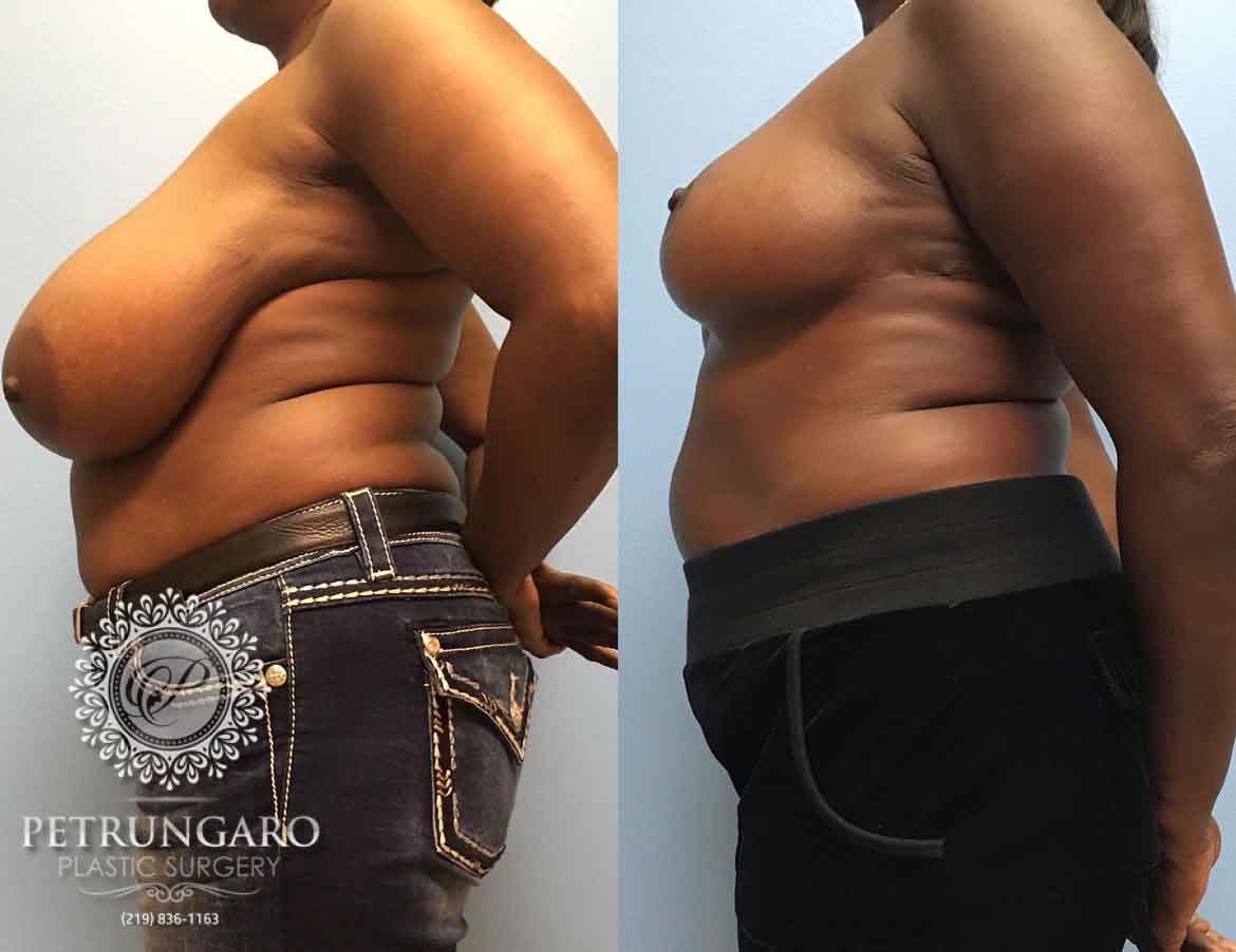 before-after-breast-reduction-1c