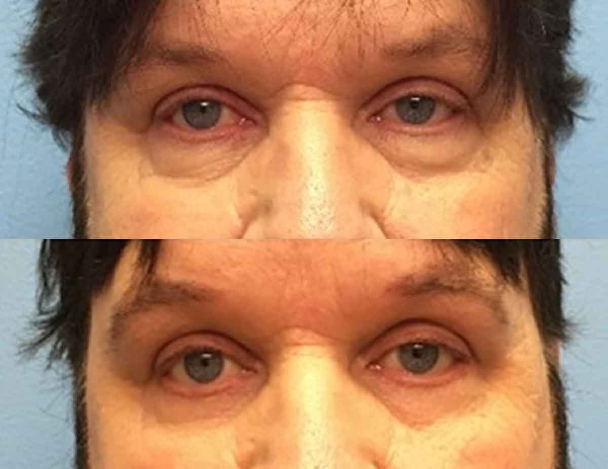 before-after-eyelid-surgery-2