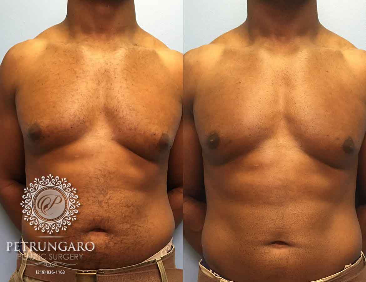 before-after-male-gynecomastia-2a