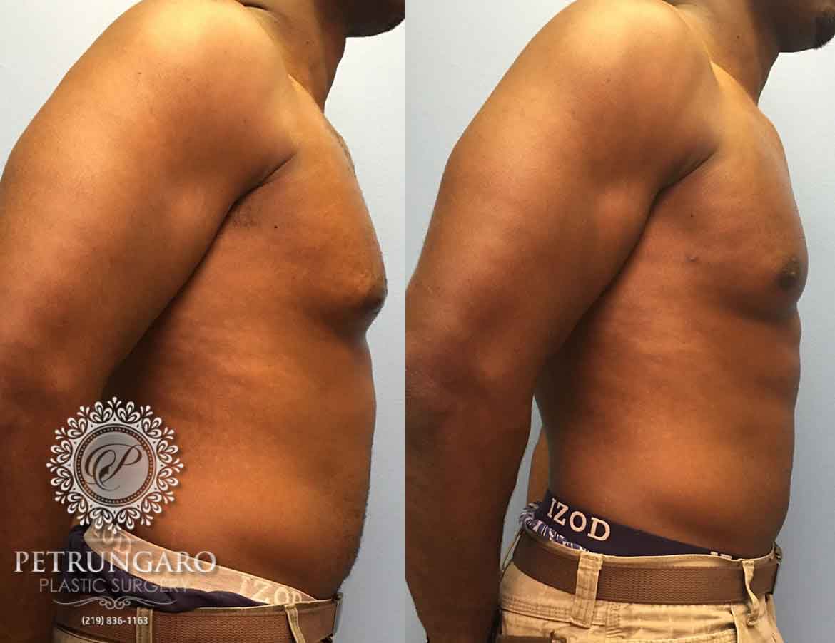before-after-male-gynecomastia-2b
