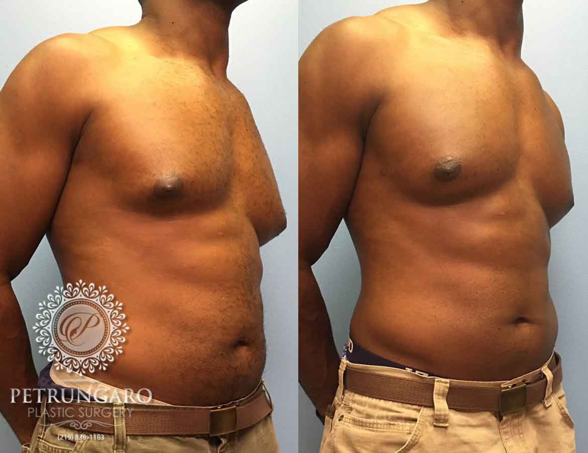 before-after-male-gynecomastia-2c