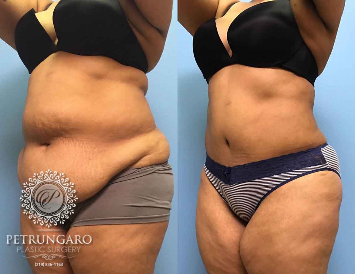 before-after-tummy-tuck-2e