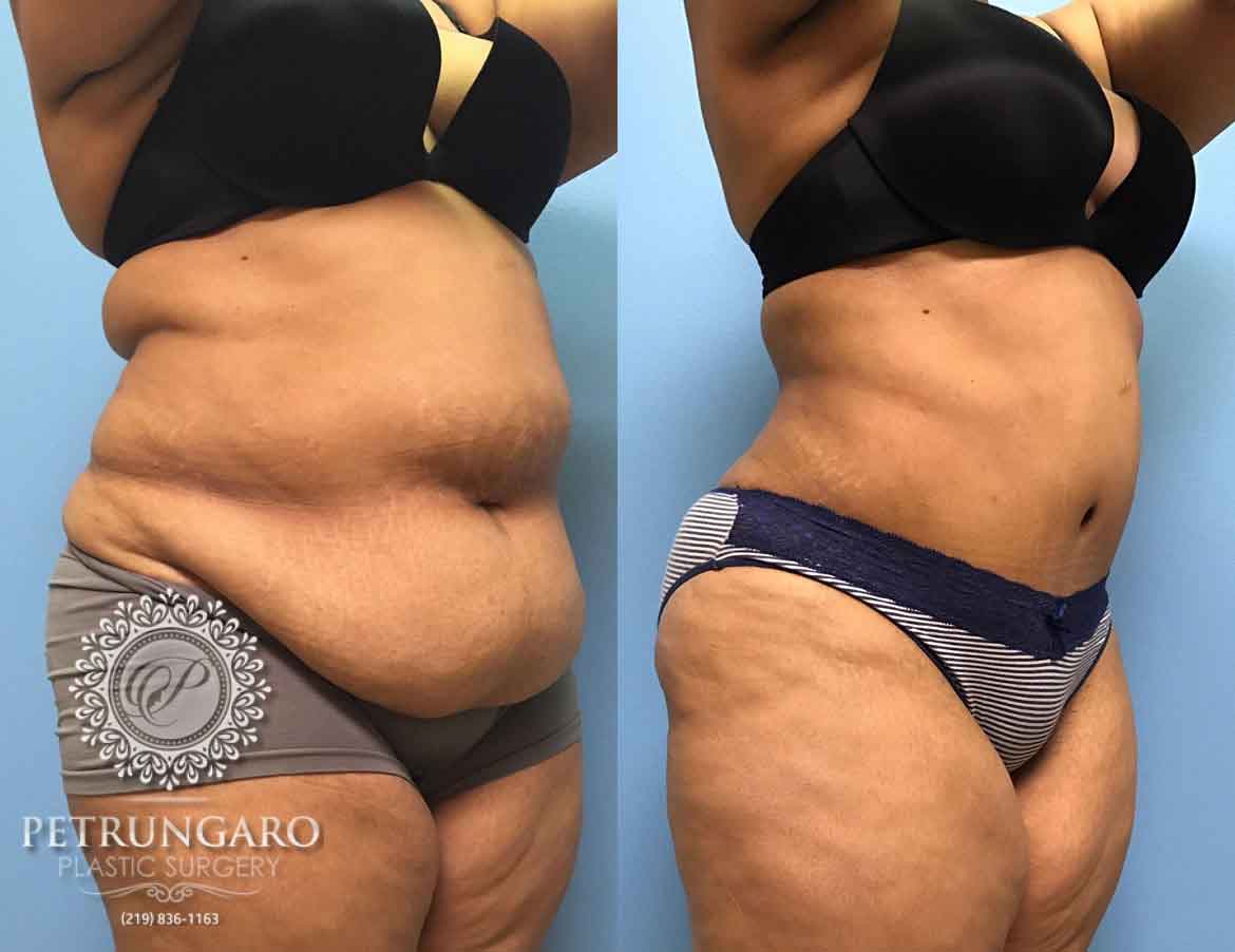 before-after-tummy-tuck-2f