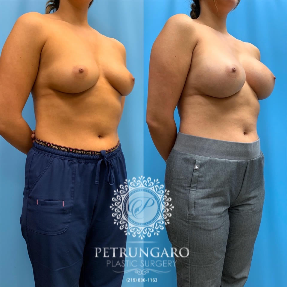 27-before-after-breast-augmentation-implants-2