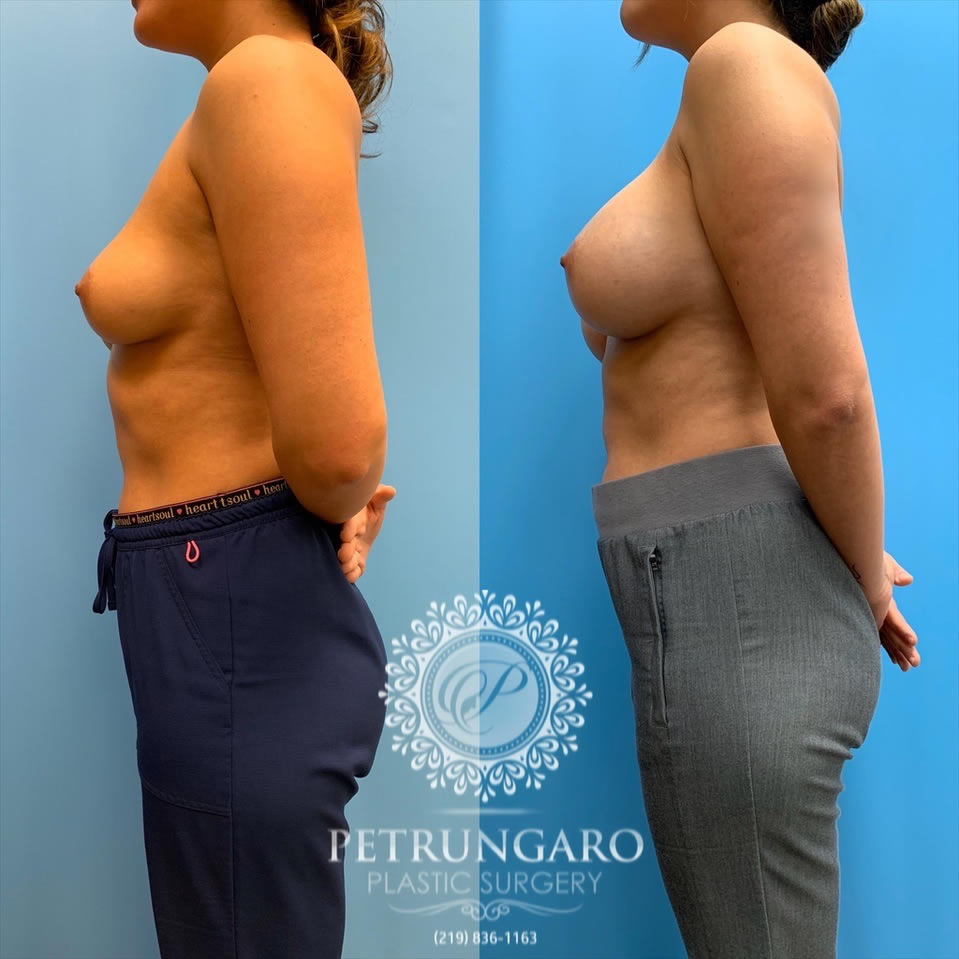 27-before-after-breast-augmentation-implants-4
