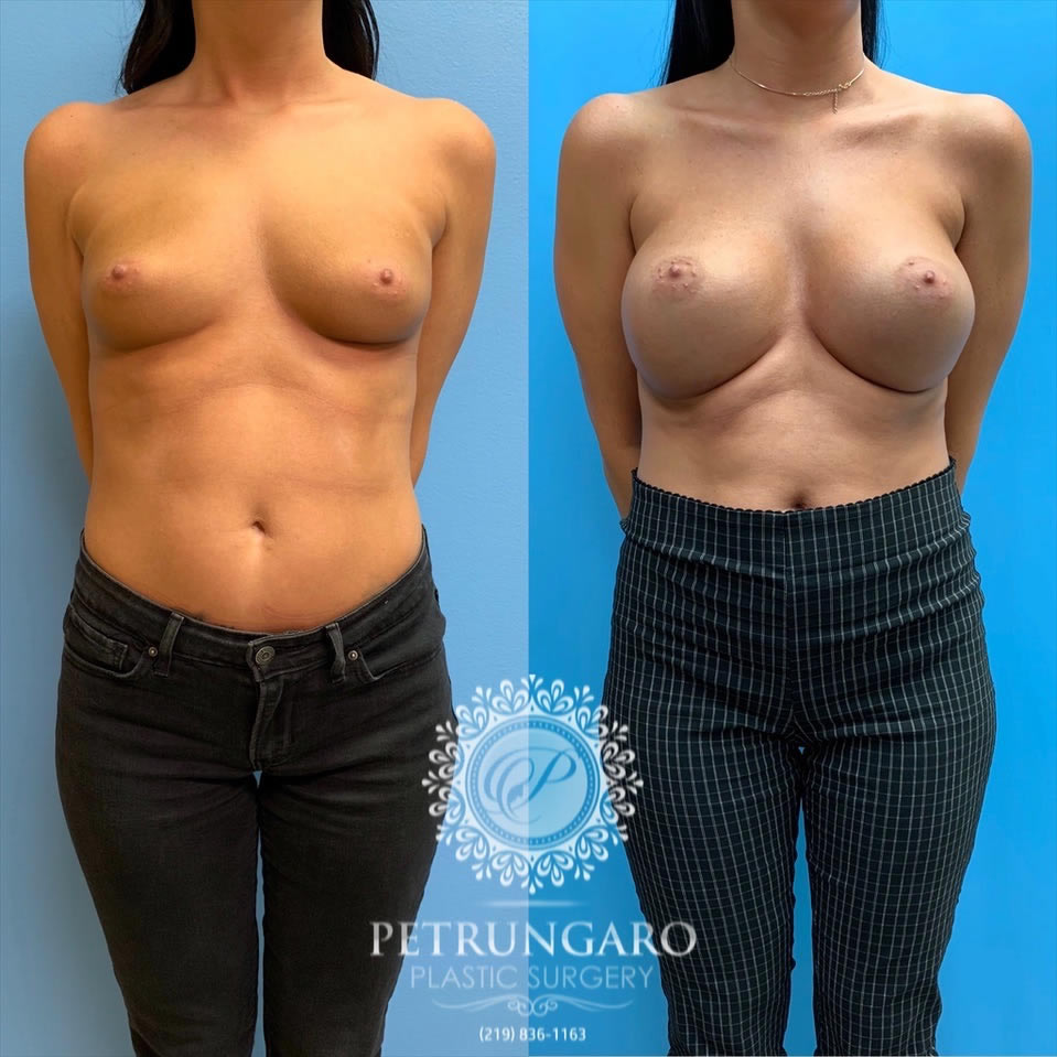 27-before-after-breast-implants-5