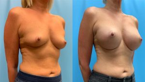 40-before-after-breast-augmentation-implants-feature