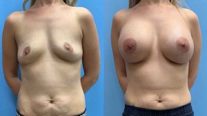 25-before-after-photos-breast-augmentation-feature-implants