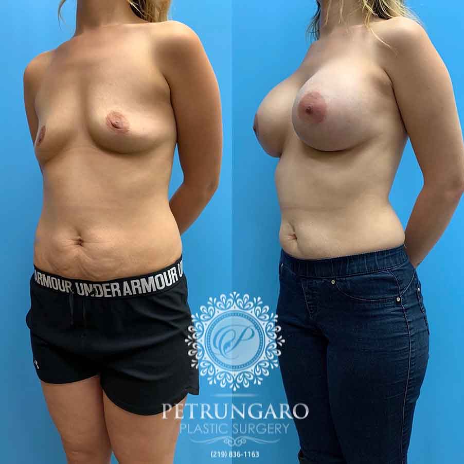 25-before-after-photos-breast-augmentation-implants-1