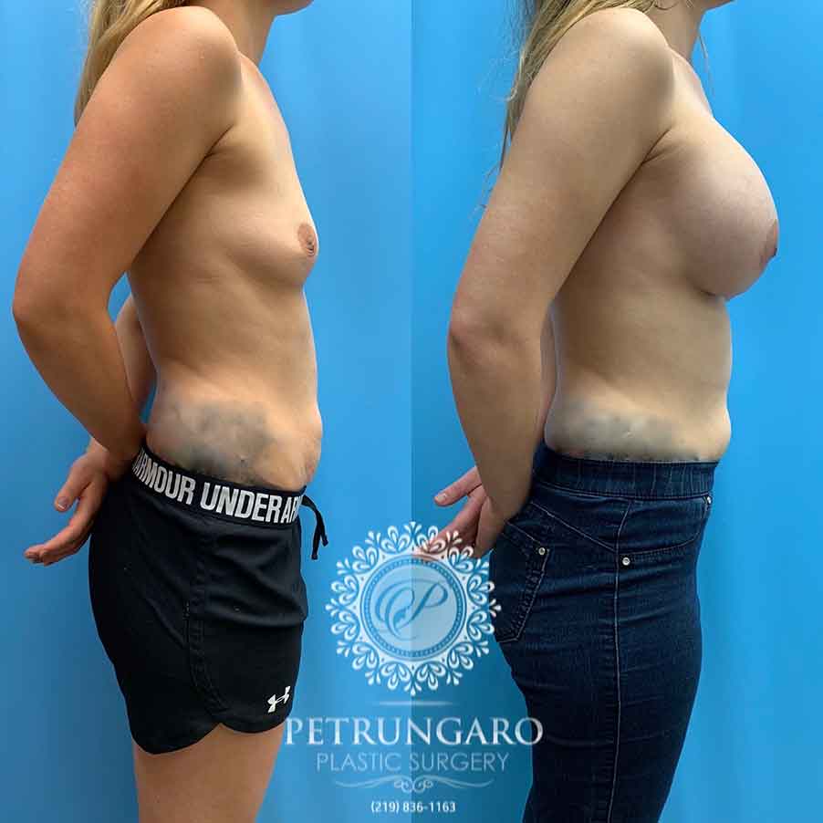 25-before-after-photos-breast-augmentation-implants-3