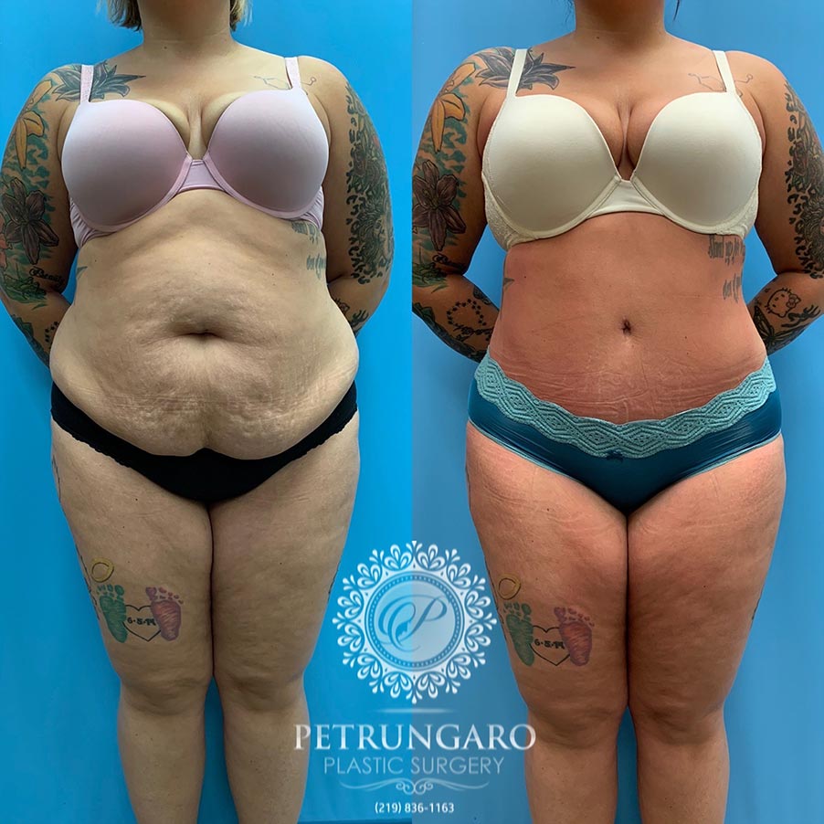 28 year old woman 3 months after Tummy Tuck with Lipo 360-1